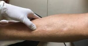 كيف أتخلص من الماء الزائد في الجسم؟